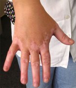 Photosensitivit Will Cause the Vitiligo