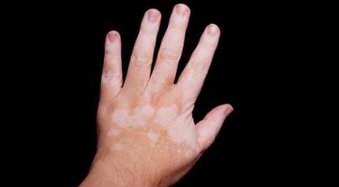 vitiligo on hand