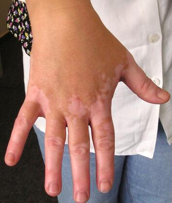 vitiligo causes