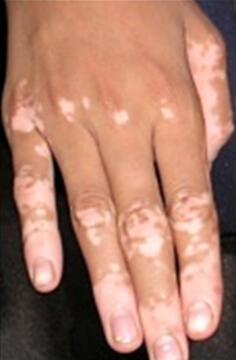 vitiligo on hands and feet