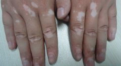 There Are Two Main Types of Vitiligo