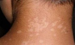 Vitiligo 2016:The Early Symptoms of Vitilig