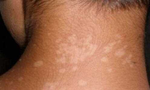 early vitiligo symptoms