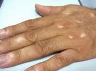 vitiligo symptom