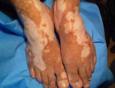 How To Distinguish Developmental Vitiligo a