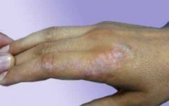 What Is Isomorphic Reaction for Vitiligo Pa