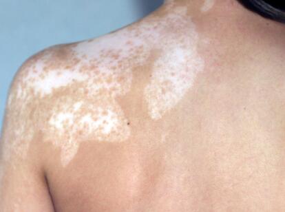 vitiligo diagnosis