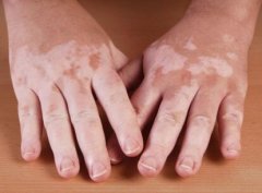 Vitiligo Treatment: Traditional Chinese Med