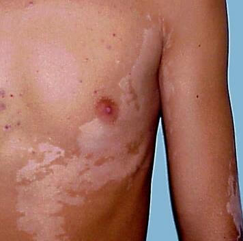 phototherapy treatment for vitiligo