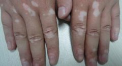 New Generation for Vitiligo: Ternary Biolog