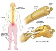 New Findings: The Causes of Vitiligo