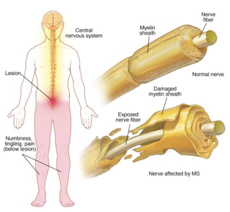 Vitiligo causes