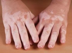 Is Vitiligo Related To Its Course