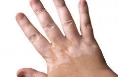 How to Deal With Progressive Stage Vitiligo