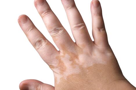 vitiligo treatment