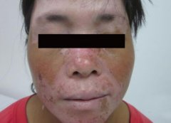 How to Protect Vitiligo Patients’ Skin in