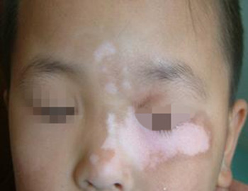 When vitiligo occur on the face 