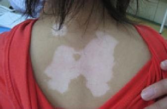 Why  vitiligo distributed in symmetrical way? 