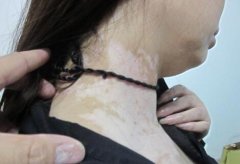 Diagnose Vitiligo Treatment Effect