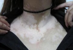 Vitiligo Causes:Why Melanin Decreases