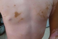 A Vitiligo Patient’s Treatment Process