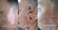 Epidermal Grafting to Treat Vitiligo