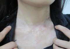 Vitiligo Treatment: 308 excimer laser thera