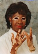 The Harm of the Vitiligo