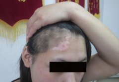 The Treatment for White Hair of Vitiligo Pa