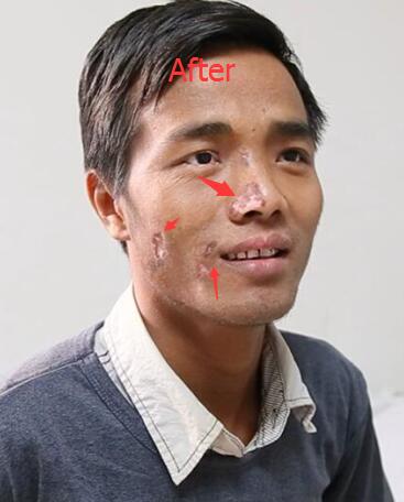  Vitiligo Treatment 