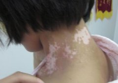 What Is The Effect of NB-UVB for Vitiligo P