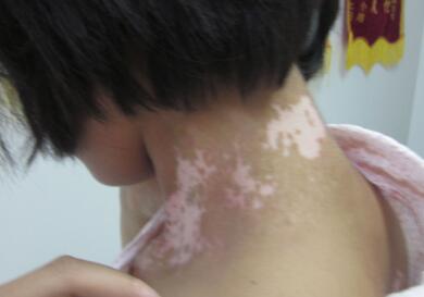 vitiligo treatment