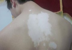 The Treatment Effect of NB-UVB for vitiligo