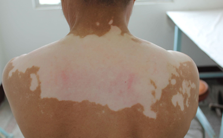 Individual difference for vitiligo patient 