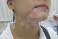 Influences for Children Vitiligo Patients