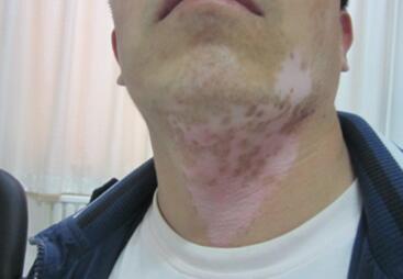 vitiligo treatment