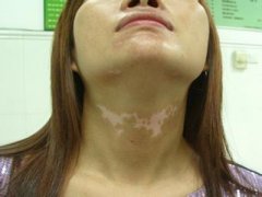 Pay More Attention to Vitiligo This Disease