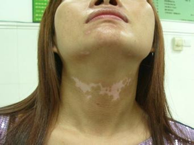 Pay more attention to vitiligo this Disease