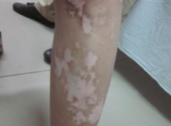 What Is the Daily Prevention for Vitiligo P