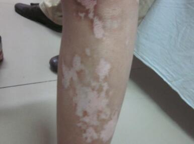 vitiligo treatment