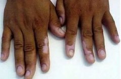 Early Symptoms for the Vitiligo