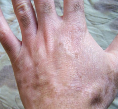 Do you know What is Vitiligo