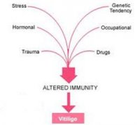 Find Vitiligo Causes And Get Specific Treat