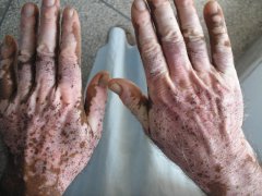 Vitiligo Treatment Needs Patience