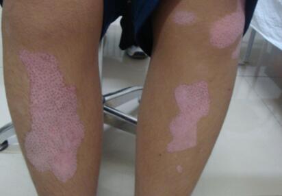 vitiligo treatment