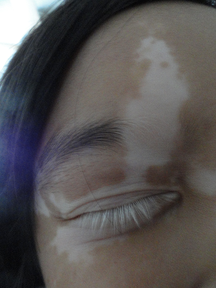 Women vitiligo patients