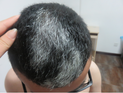 Vitiligo patients with gray hair