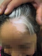 Is White Hair Related to Vitiligo