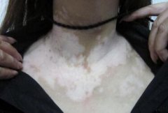 Bad Habits Can Induce Vitiligo