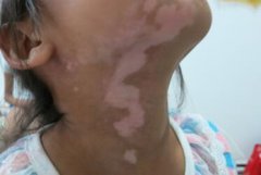 Why Vitiligo is Easy to Relapse